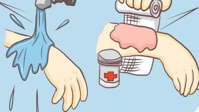 烫伤